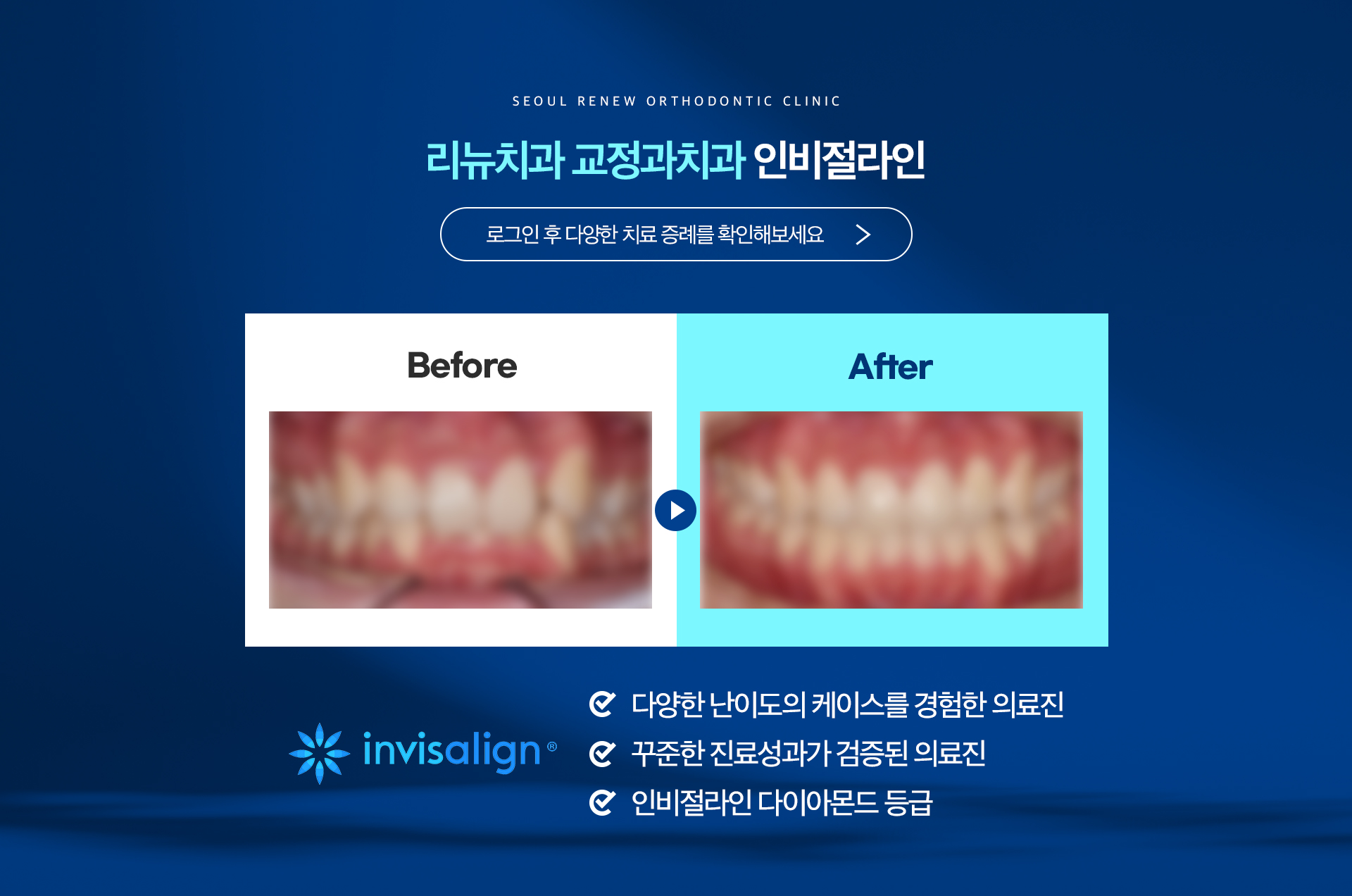 리뉴치과 교정과치과 인비절라인